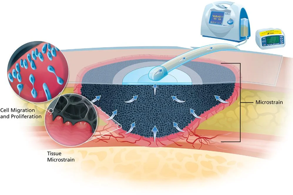 طرز کار دستگاه وکیوم تراپی زخم